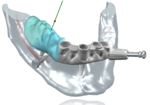 Chirurgie-guidee-300x210